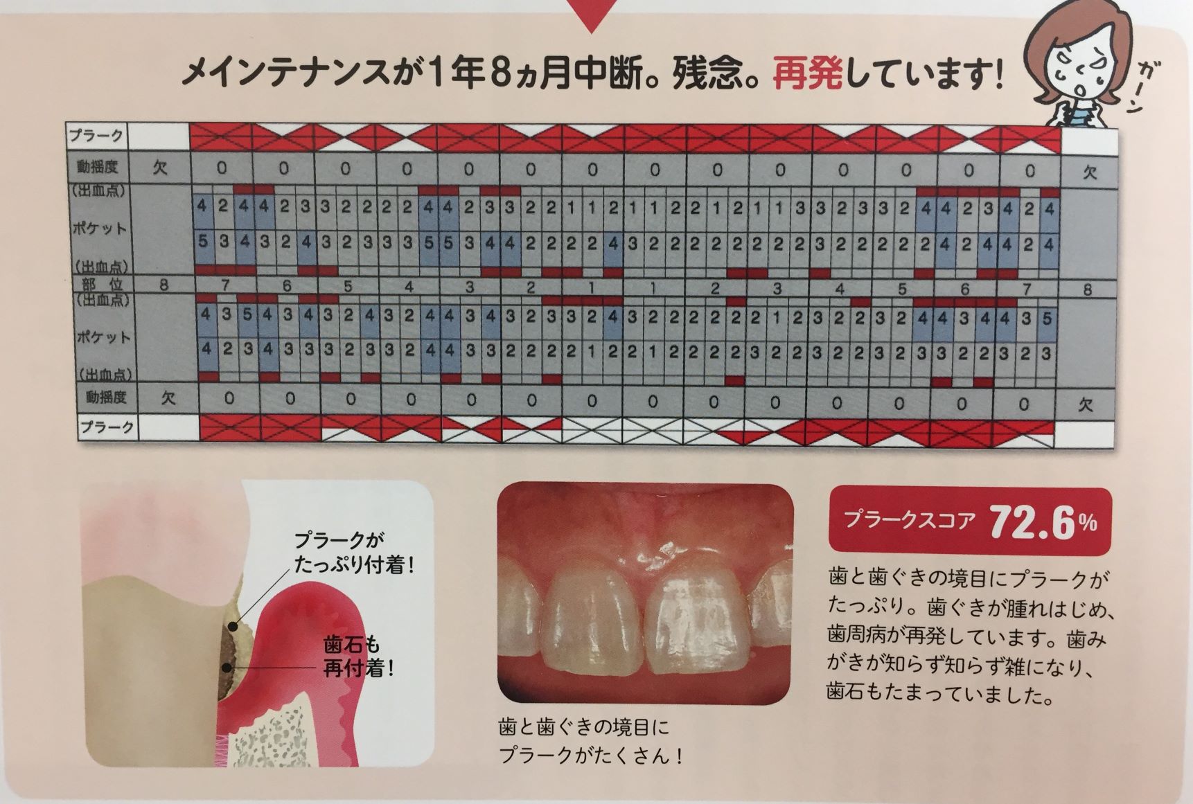 再発予防にはメインテナンスが必須！ーえちごやタウン歯科｜山形県東根市の歯医者